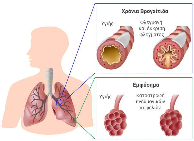 Πνευμονολόγος Βρογχίτιδα Βήχας Εμφύσημα
